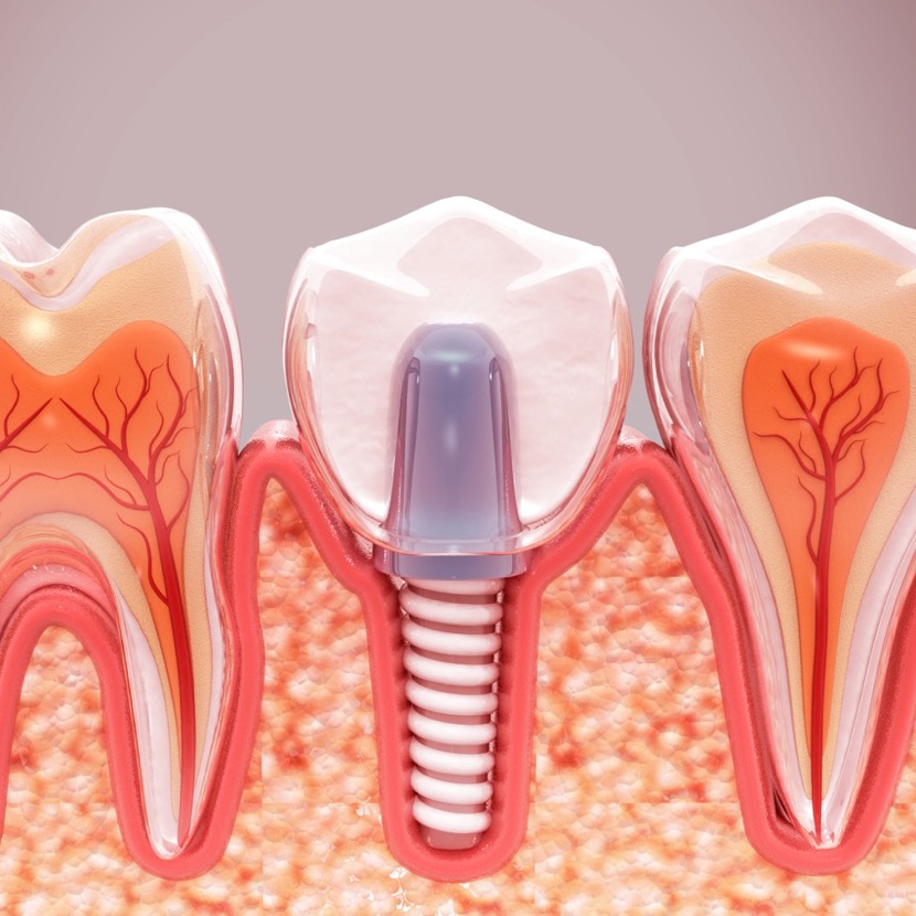 インプラント（Implant）とは人工的な歯根のこと